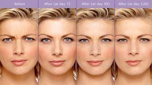 Botulinum Toxin (Botox) Procedure Steps | Palm Desert Plastic Surgery