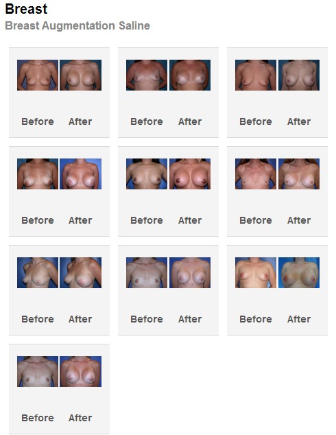 Palm Springs  Rancho Mirage Breast Augmentation Before After Photos