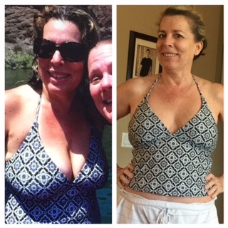 Breast Reduction Before & After Photos