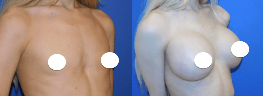 Transgender Breast Augmentation