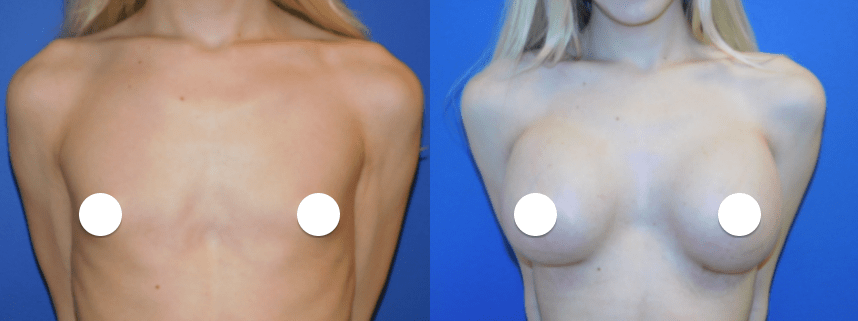 Transgender Breast Augmentation