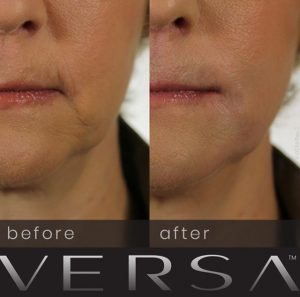 Revanesse Versa Dermal Filler Before And After Photos