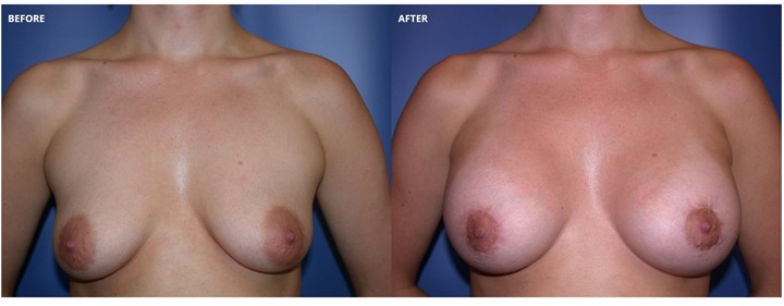 Breast Lift With Implants Before And After Photos 