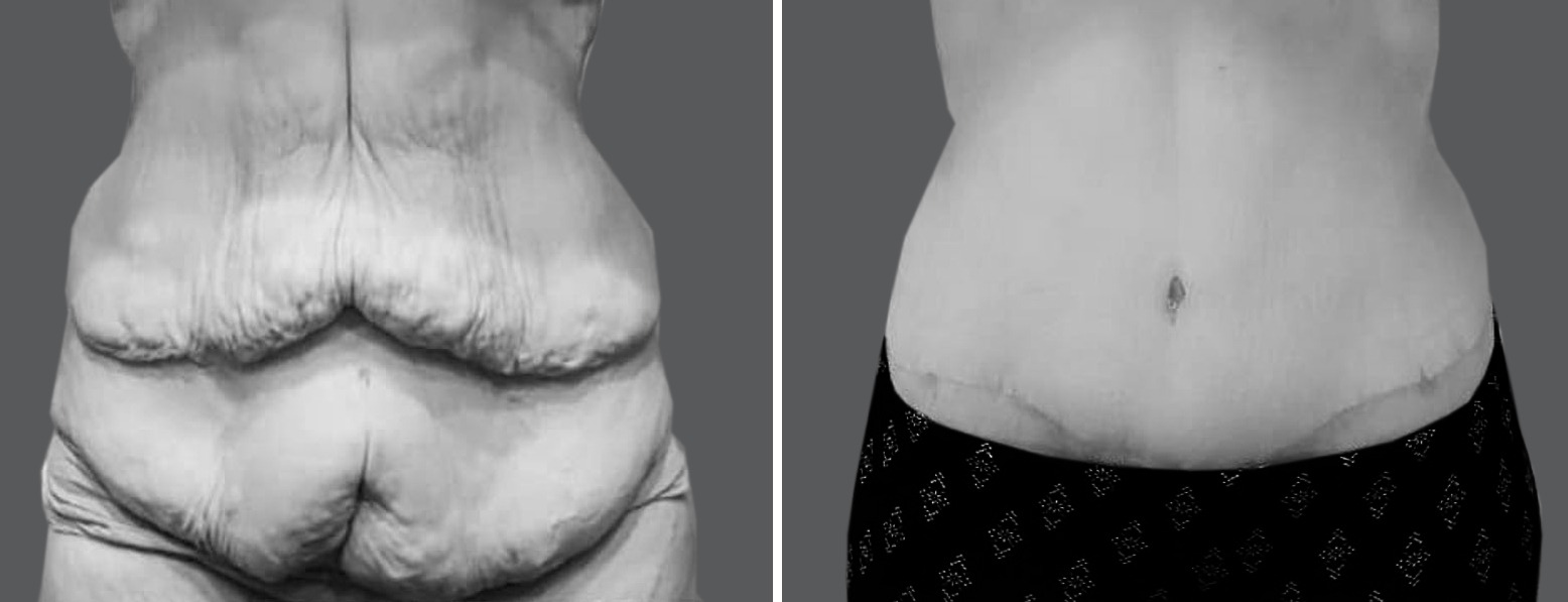 Skin Removal Surgery After Weight Loss Surgery