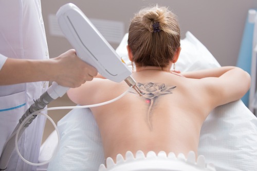 Laser Tattoo Removal &#8211; Palm Springs Med Spa