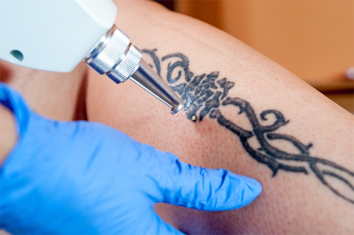 Most Frequently Asked Questions From Tattoo Removal Patients