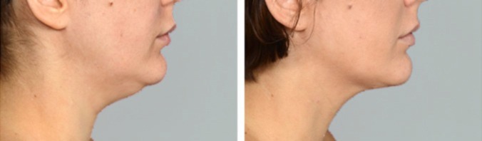 Facial Liposuction Before And After Photos
