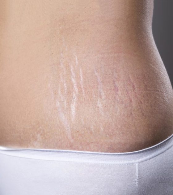 How To Treat Stretch Marks   The AEDITION