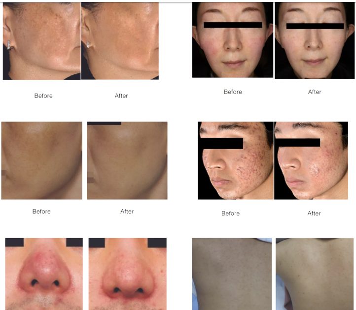 Sylfirm X Vascular Vein &#038; Pigmentation Removal Microneedling Treatments for Your Face