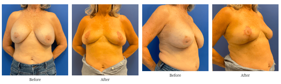 Breast Explantation Without Deformity – The Q-Flap™
