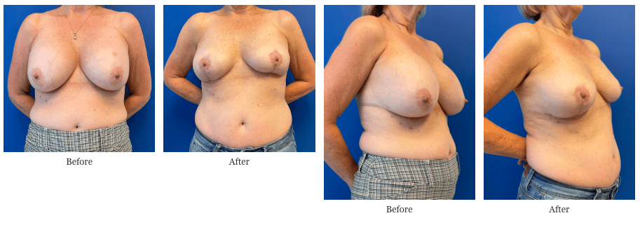 Breast Explantation Without Deformity – The Q-Flap™
